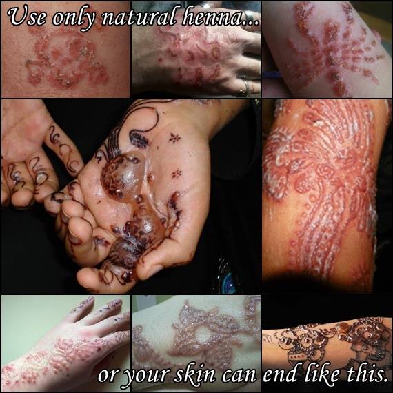 Entzündungserscheinungen der Haut nach dem Gebrauch von kommerziellen Henna-Cones bzw. Tuben oder Spritztfüten, die höchstwahrscheinlich PPD enthielten.